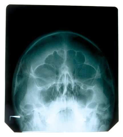 brain-x-ray.jpg